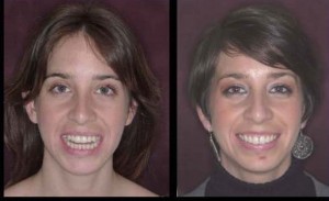 Figura 17a. Comparación de fotografías de cara antes y después del tratamiento. Destacamos que en la fotografía inicial la paciente está en sonrisa forzada.