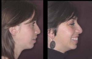 Figura 17b. Fotografía de perfi l, antes y después del tratamiento.