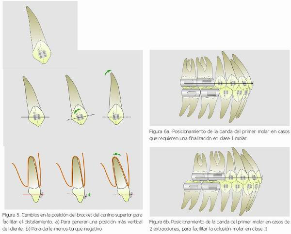 Corrección de rotaciones dentarias con Arco Recto: componentes
